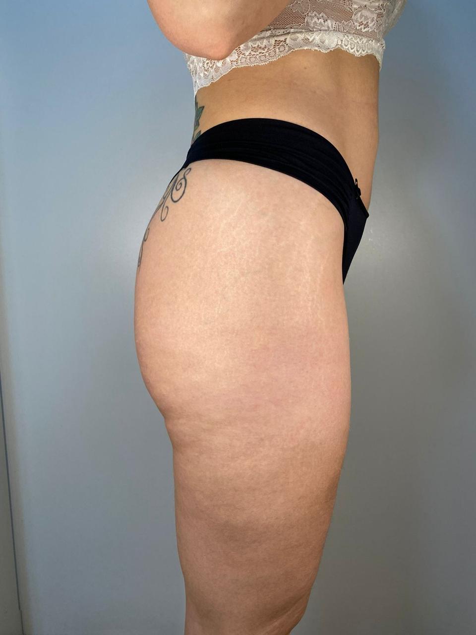 Preenchimento Águas Claras - 1