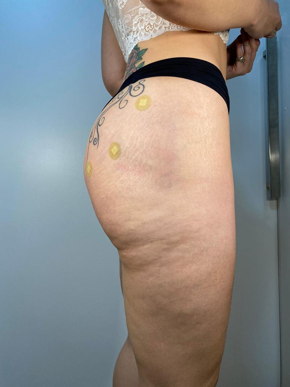 Preenchimento Águas Claras - 2