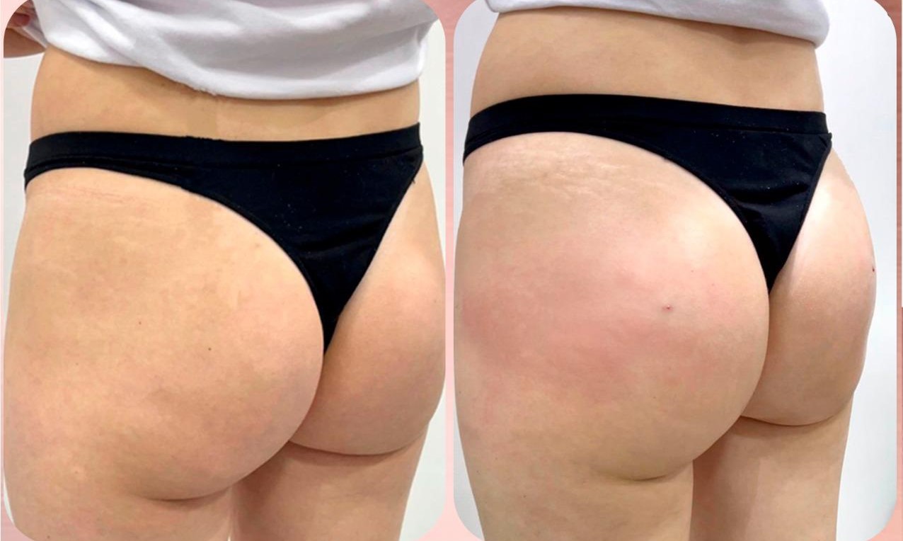 Preenchimento Águas Claras - 3