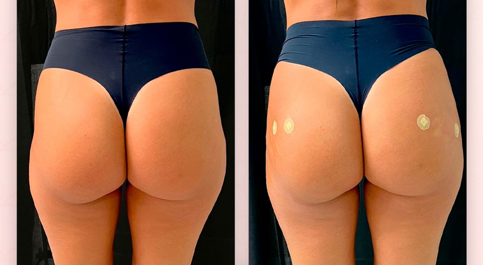 Preenchimento Águas Claras - 4