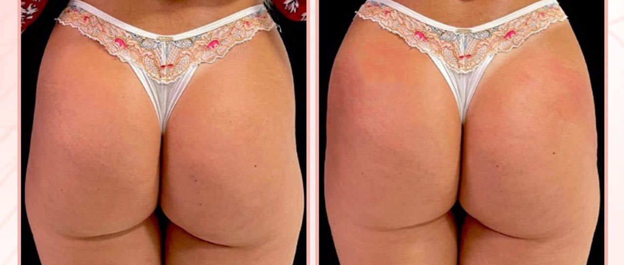 Preenchimento Águas Claras - 5