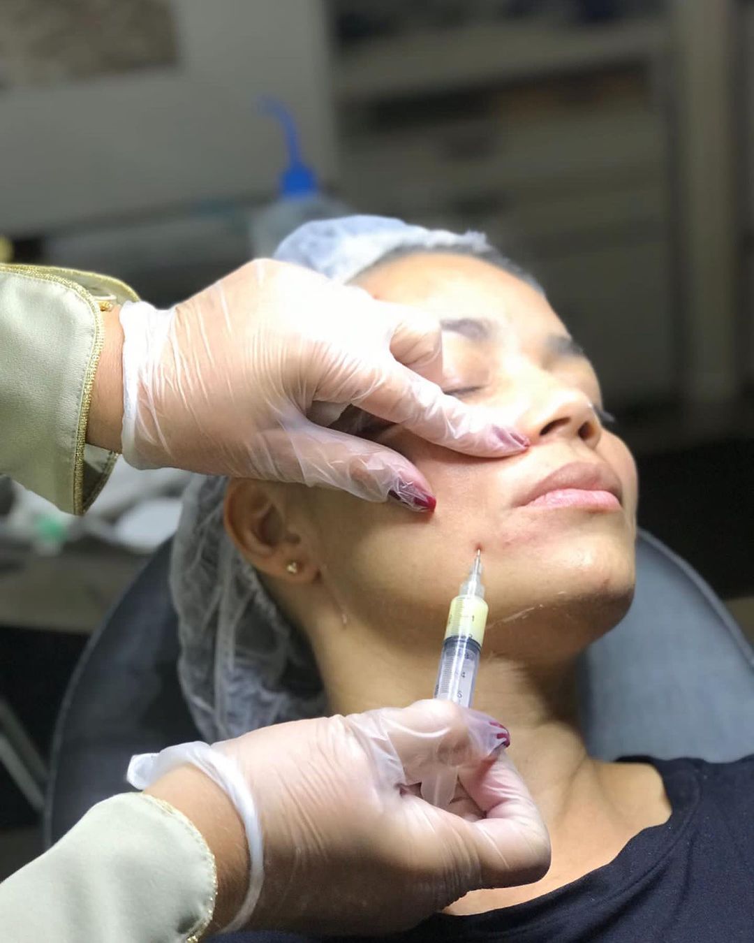 Preenchimento Facial Pasmagel