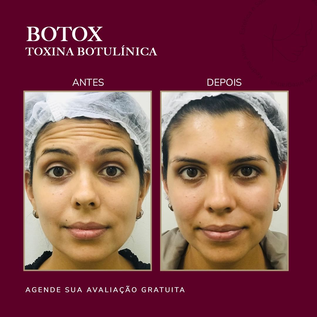 Toxina Btx Águas Claras - 11