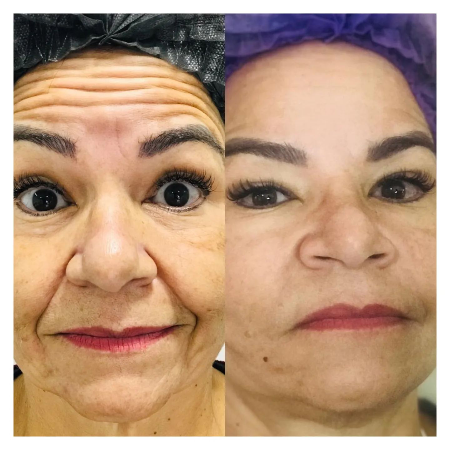 Toxina Btx Águas Claras - 13