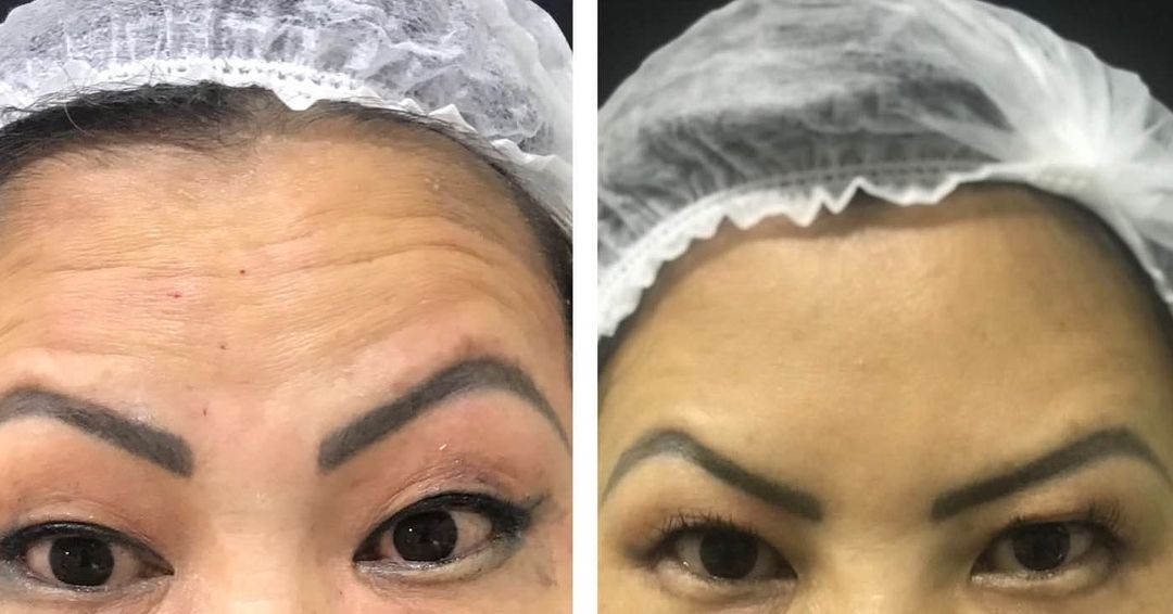 Toxina Btx Águas Claras - 14