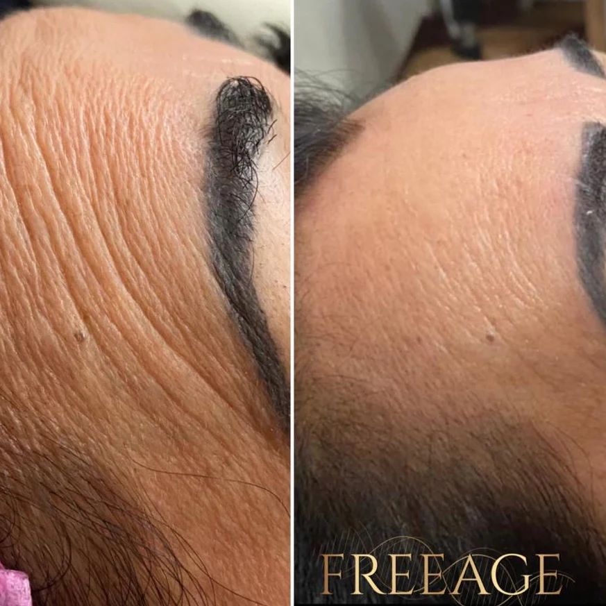 Toxina Btx Águas Claras - 2