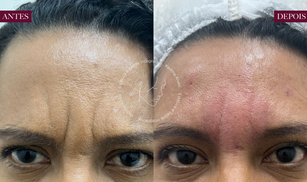 Toxina Btx Águas Claras - 3