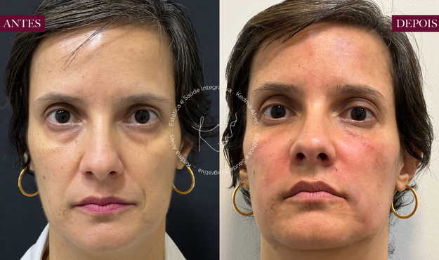 Toxina Btx Águas Claras - 4