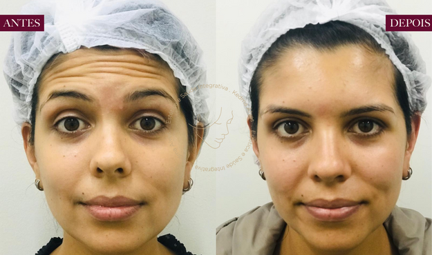 Toxina Btx Águas Claras - 5