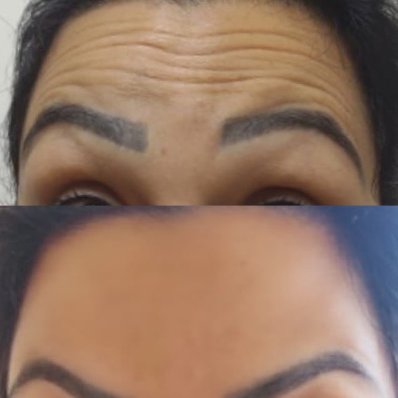 Toxina Btx Águas Claras - 7