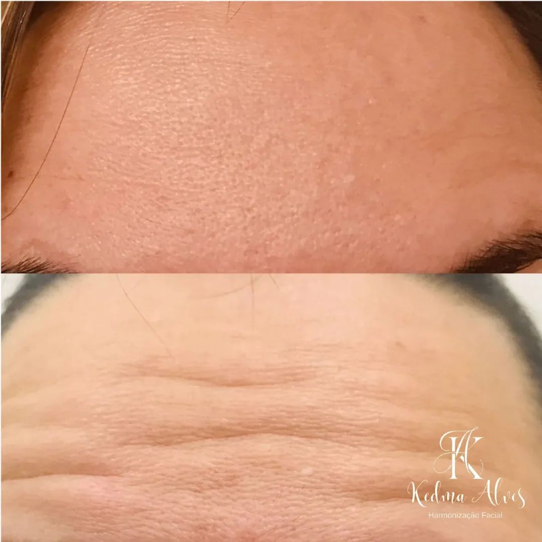 Toxina Btx Águas Claras - 8