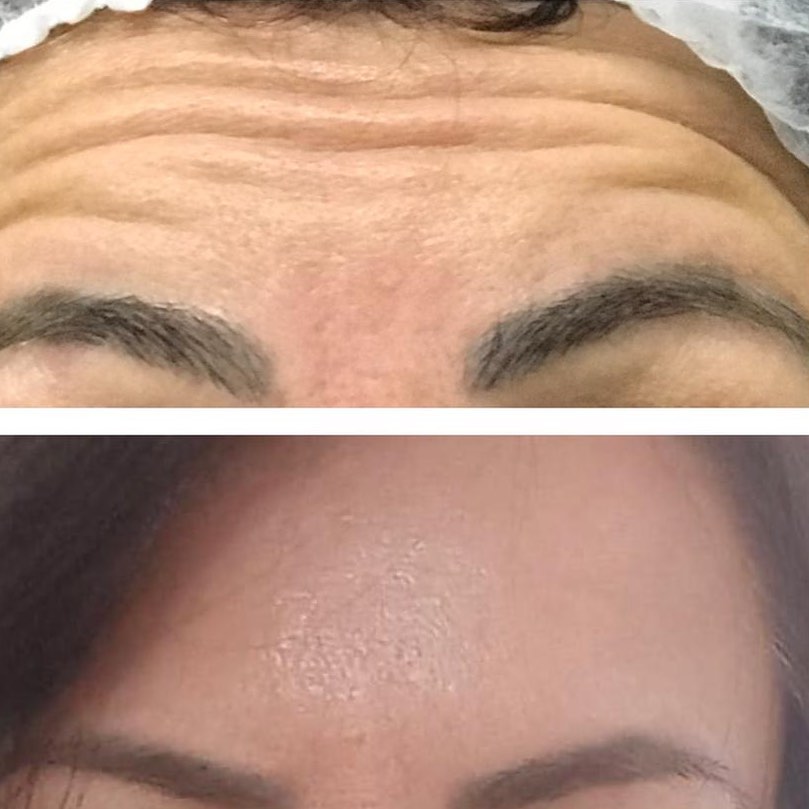 Toxina Btx Águas Claras - 9